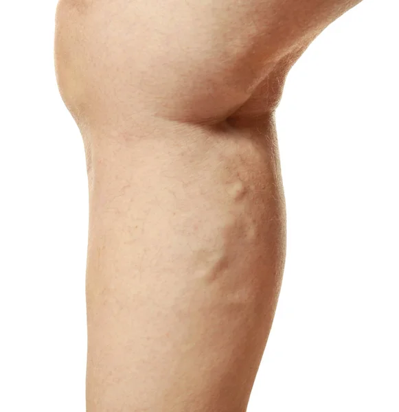 Menschliches Bein mit Krampfadern — Stockfoto