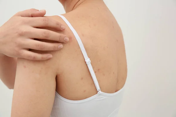 Woman scratching shoulder — Stock Photo, Image
