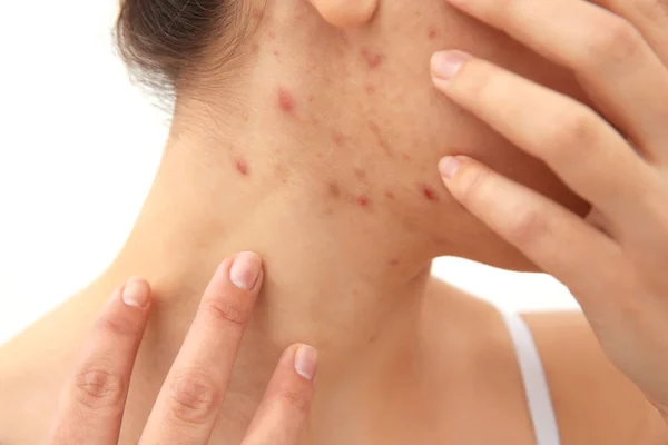 Young woman with pimples — Stock Photo, Image