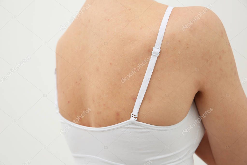 woman with rash on back