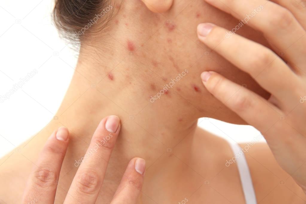 young woman with pimples 