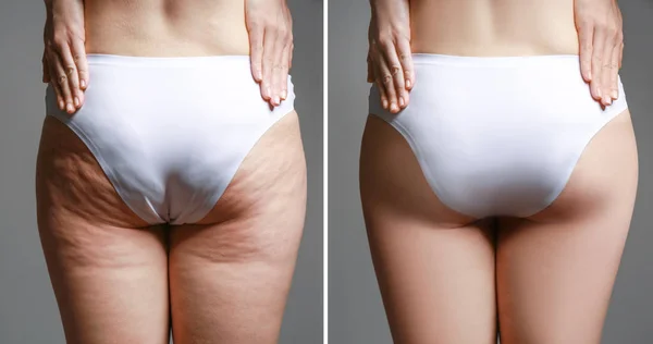 Body before and after anti cellulite treatment — Stock Photo, Image