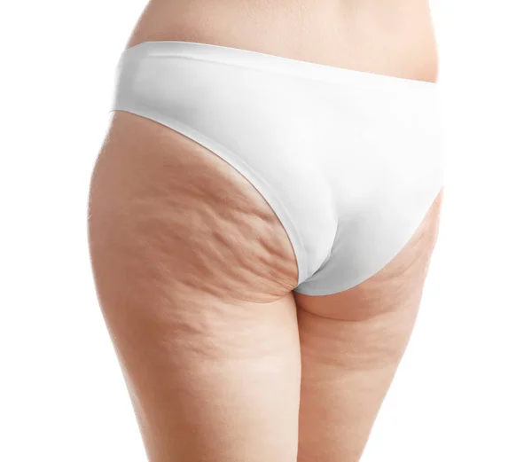 Woman with cellulite on buttocks — Stock Photo, Image