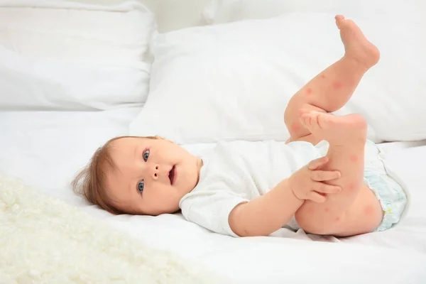 Anak Kecil Dengan Ruam Merah Tergeletak Tempat Tidur Konsep Alergi — Stok Foto
