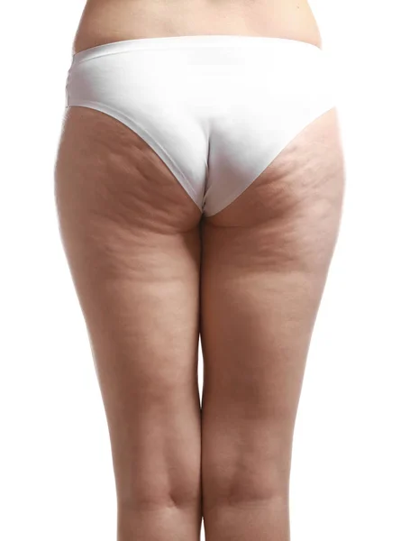 Frau mit Cellulite-Problem — Stockfoto