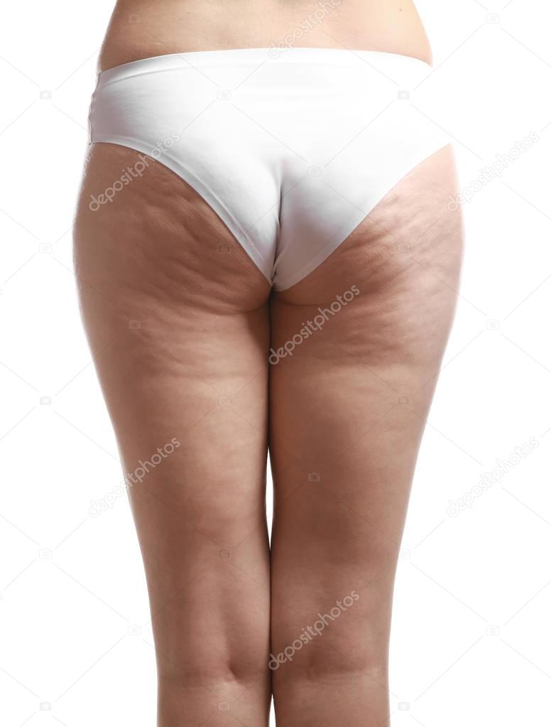 Woman with cellulite problem