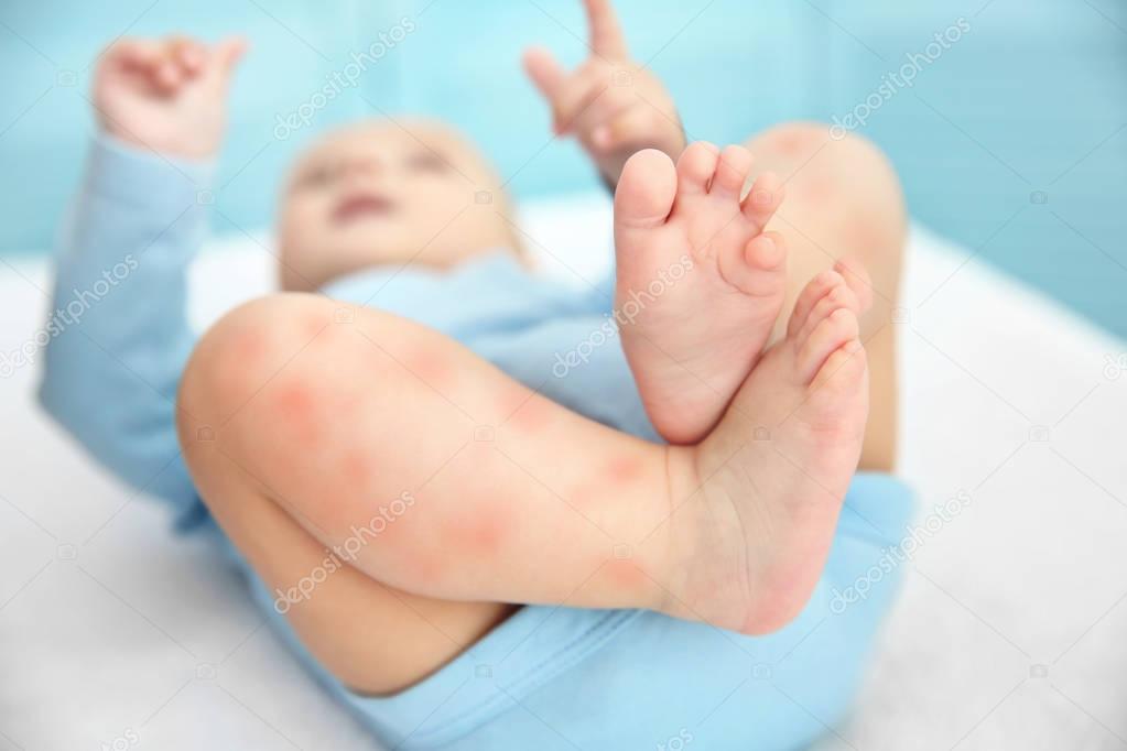 Legs of little child with red rash