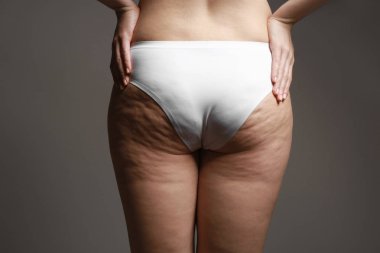 Selülit sorunu olan kadın