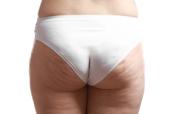 Donna con problemi di cellulite — Foto Stock