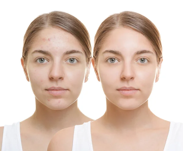 Young Woman Acne Treatment White Background Skin Care Concept — Stock Photo, Image
