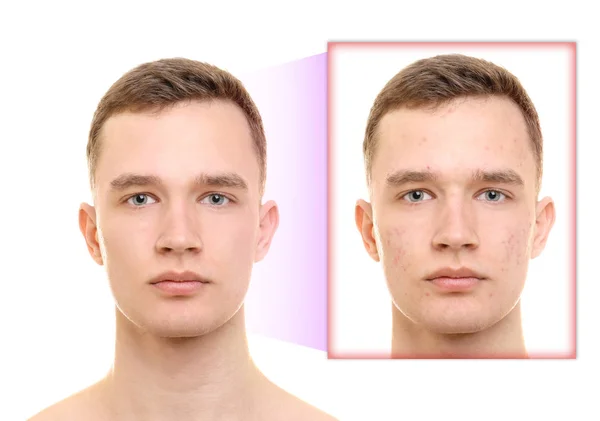 Giovane Uomo Prima Dopo Trattamento Dell Acne Sfondo Bianco Concetto — Foto Stock