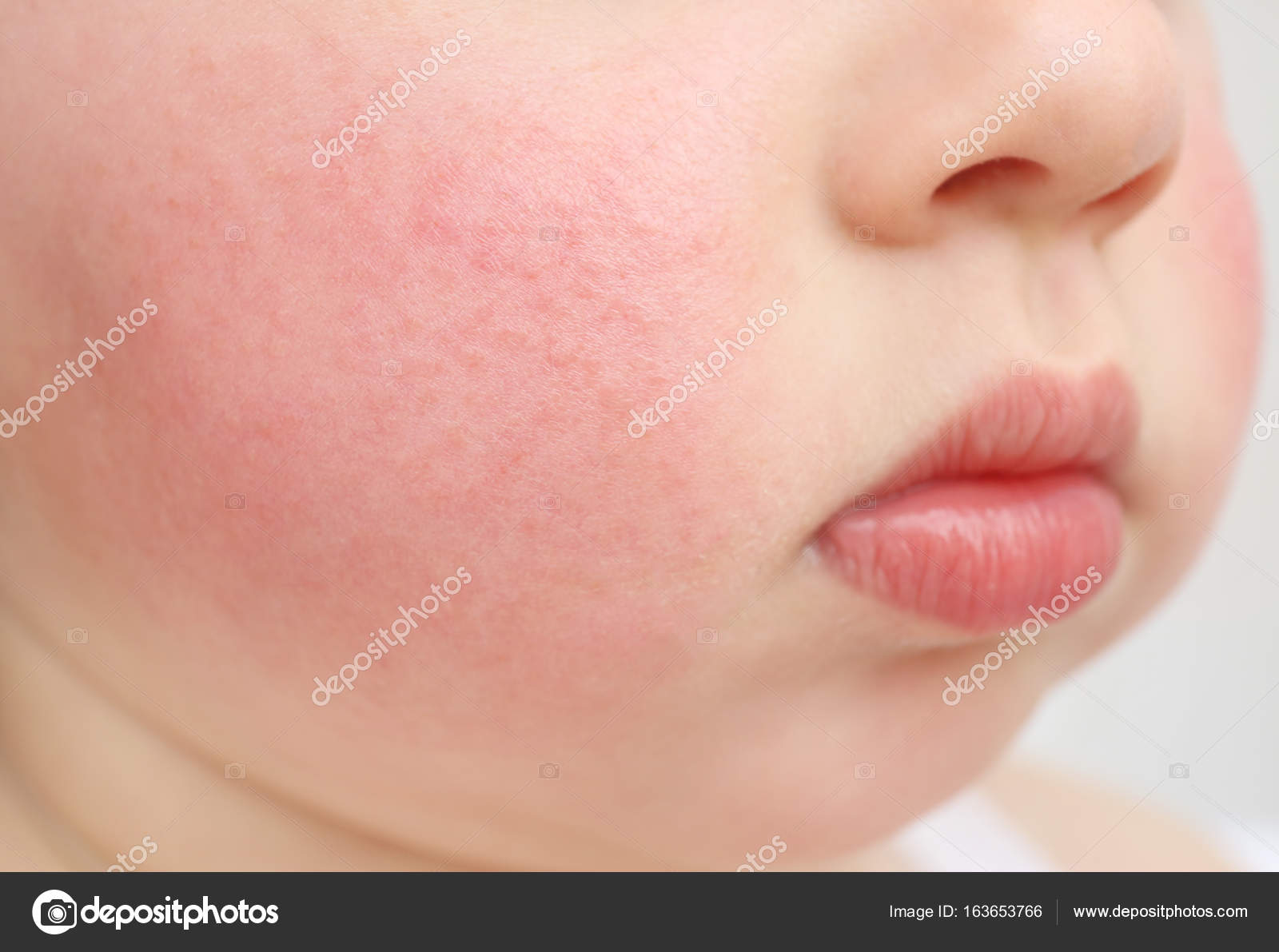Little child with diathesis symptoms on cheeks, closeup — Stock