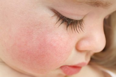 Yanaklarda, closeup diyatez semptomları olan küçük çocuk