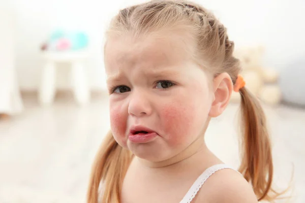 Portrait of little crying girl with diathesis symptoms in light room — Stock Photo, Image