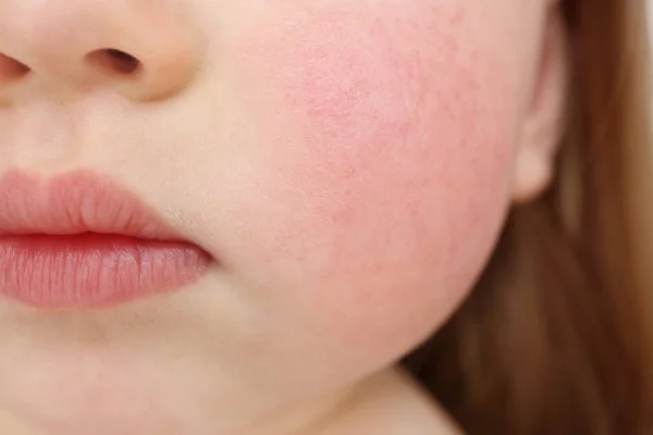 Маленький ребенок с симптомами диатеза на щеках, крупным планом — стоковое фото