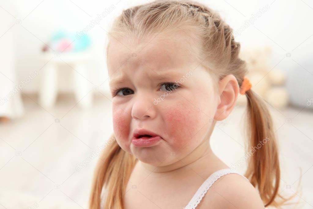Portrait of little crying girl with diathesis symptoms in light room