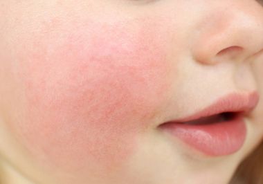 Yanaklarda, closeup diyatez semptomları olan küçük çocuk