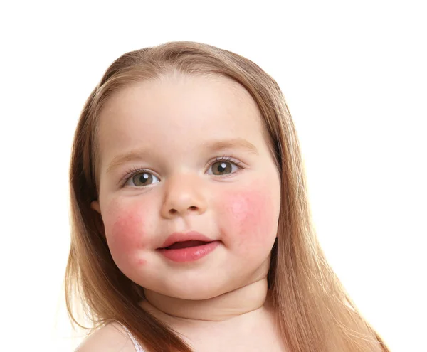 Retrato de niña con síntomas de diátesis en las mejillas, sobre fondo blanco —  Fotos de Stock