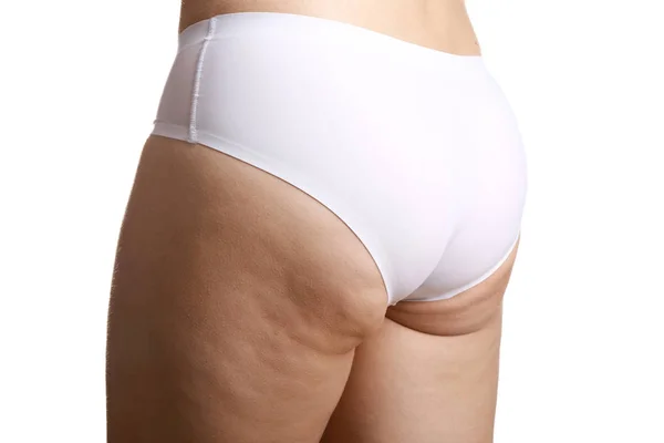 Frau mit Cellulite-Problem auf weißem Hintergrund — Stockfoto