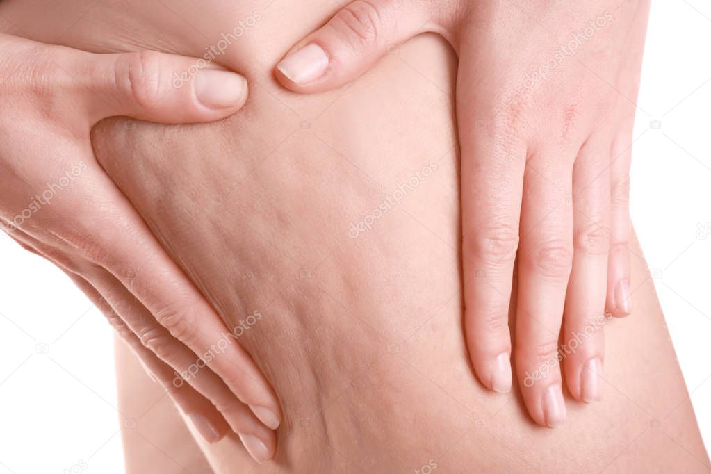 Woman with cellulite problem, closeup