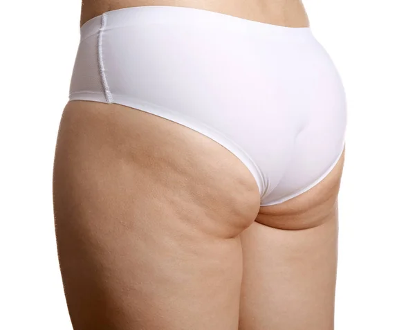 Γυναίκα με το πρόβλημα cellulite σε λευκό φόντο — Φωτογραφία Αρχείου