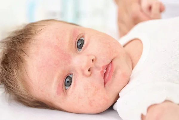 Bayi manis dengan alergi kulit, closeup — Stok Foto