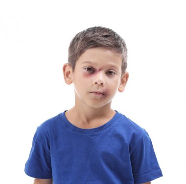 Little boy with bruises on white background. Domestic violence concept