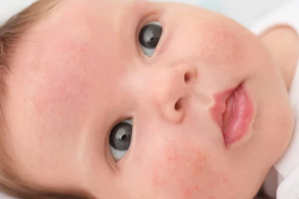 Schattig baby met een huid allergie, close-up — Stockfoto