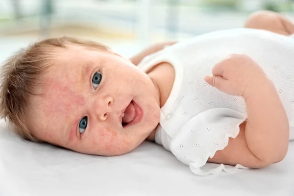 Bayi manis dengan alergi kulit di dalam ruangan — Stok Foto