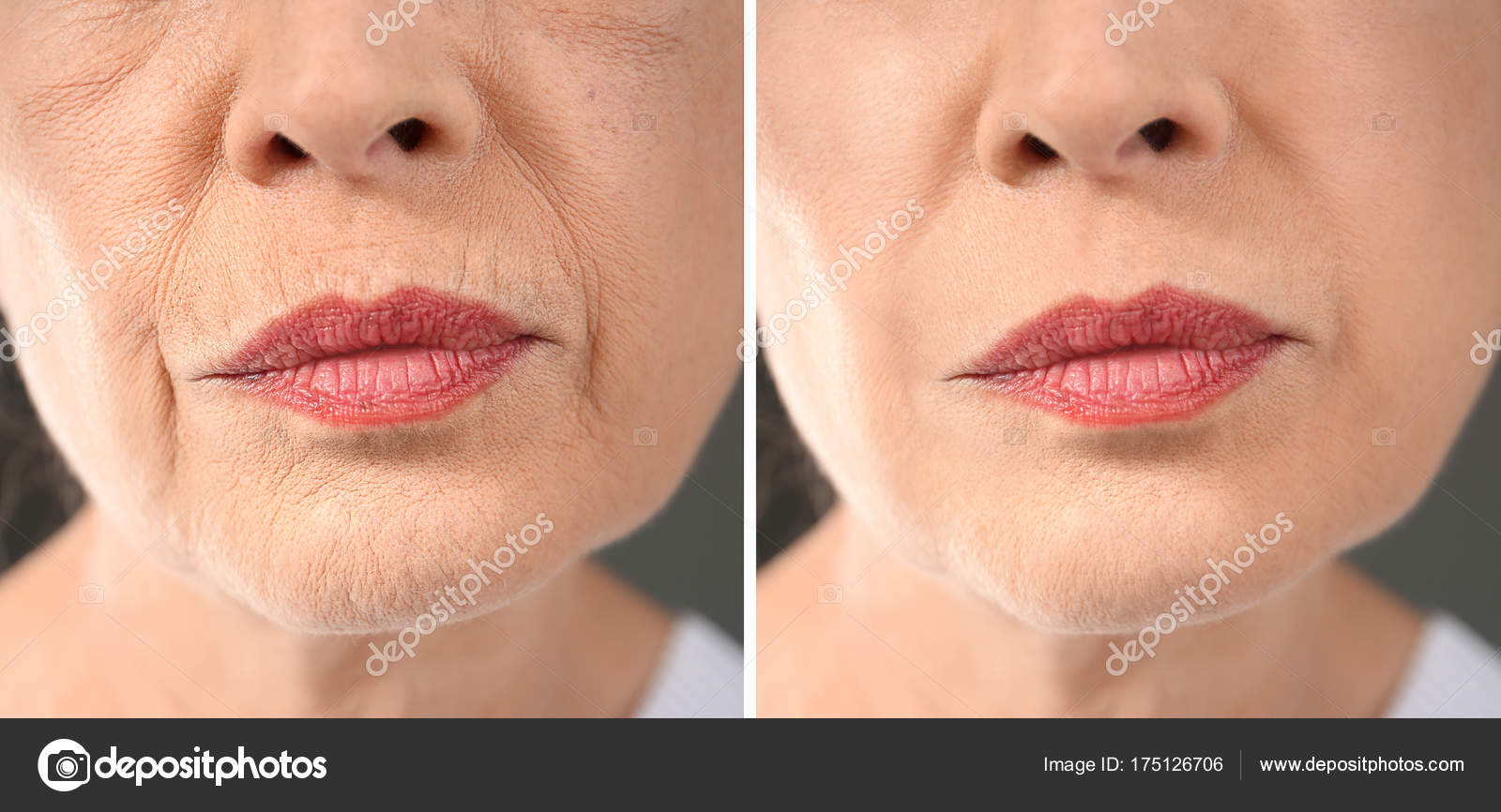 Senior woman before and after biorevitalization procedure, closeup
