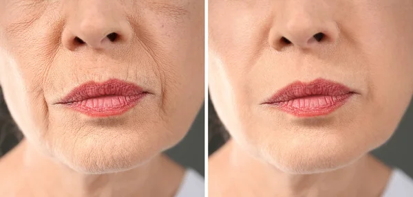 Mulher idosa antes e depois do procedimento de biorevitalização, close-up — Fotografia de Stock