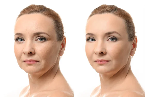 Zralá žena před a po proceduře biorevitalization na bílém pozadí — Stock fotografie