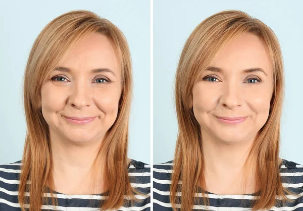 Kadın önce ve sonra biorevitalization yordam — Stok fotoğraf