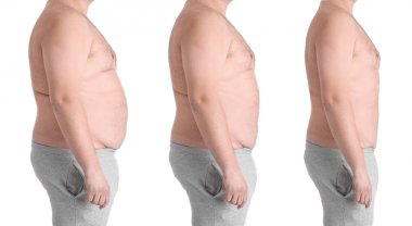 Kilolu adam önce ve sonra kilo kaybı 