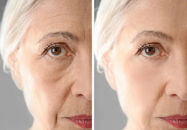 Starší žena před a po zákroku biorevitalization, closeup — Stock fotografie