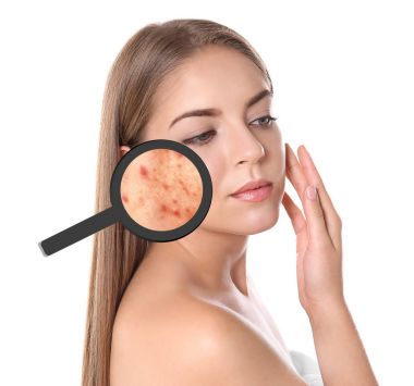 Young woman with magnifying glass showing acne on face against white background clipart