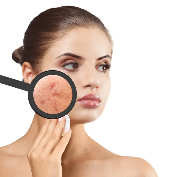 Young woman with magnifying glass showing acne on face against white background — Stock Photo, Image