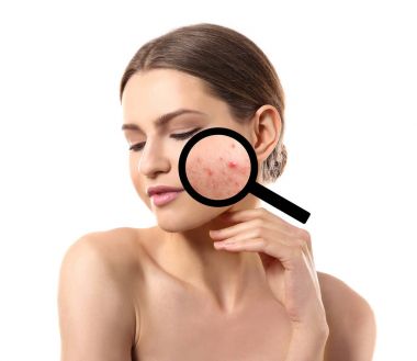 Young woman with acne on face  clipart