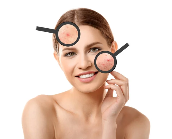 Young woman with acne on face — Stock Photo, Image
