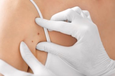 Hasta, closeup doğum izine benzer inceleyerek dermatolog. Kanser kavramı