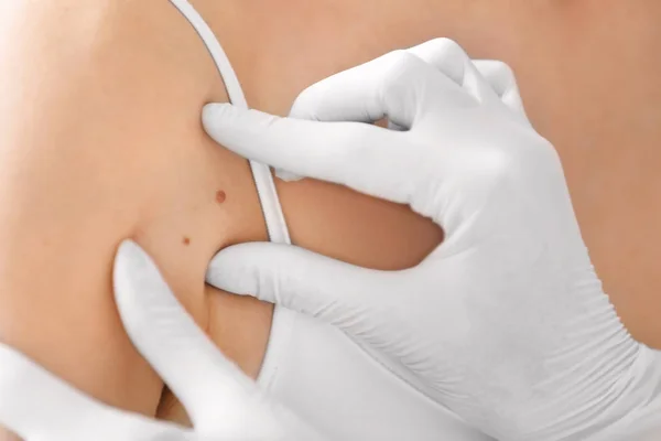 Dermatologista examinando marca de nascença do paciente, close-up. Conceito de cancro — Fotografia de Stock