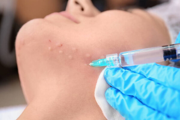 Красавчик делает укол женщине в лицо крупным планом. Процедура биоревитализации
