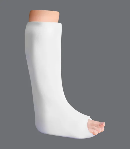 Επιχρισμένοι πόδι. Θεραπεία της ένα σπασμένο πόδι. Ιατρικής και της υγείας. Απομονωμένο αντικείμενο. Διάνυσμα — Διανυσματικό Αρχείο