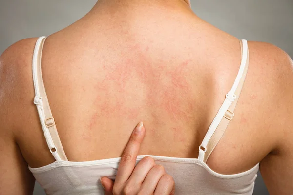 Woman scratching her itchy back with allergy rash — Stock Photo, Image