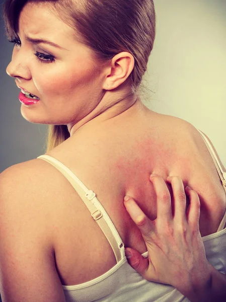 Жінка подряпає свербіж назад алергічним висипом — стокове фото