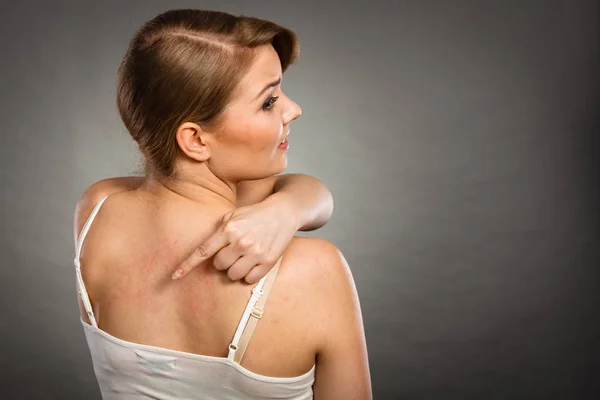 Vrouw haar jeukende terug met allergie huiduitslag krabben — Stockfoto