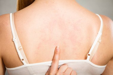 Anti döküntü ile kaşıntılı onu geri tırmalamak kadın