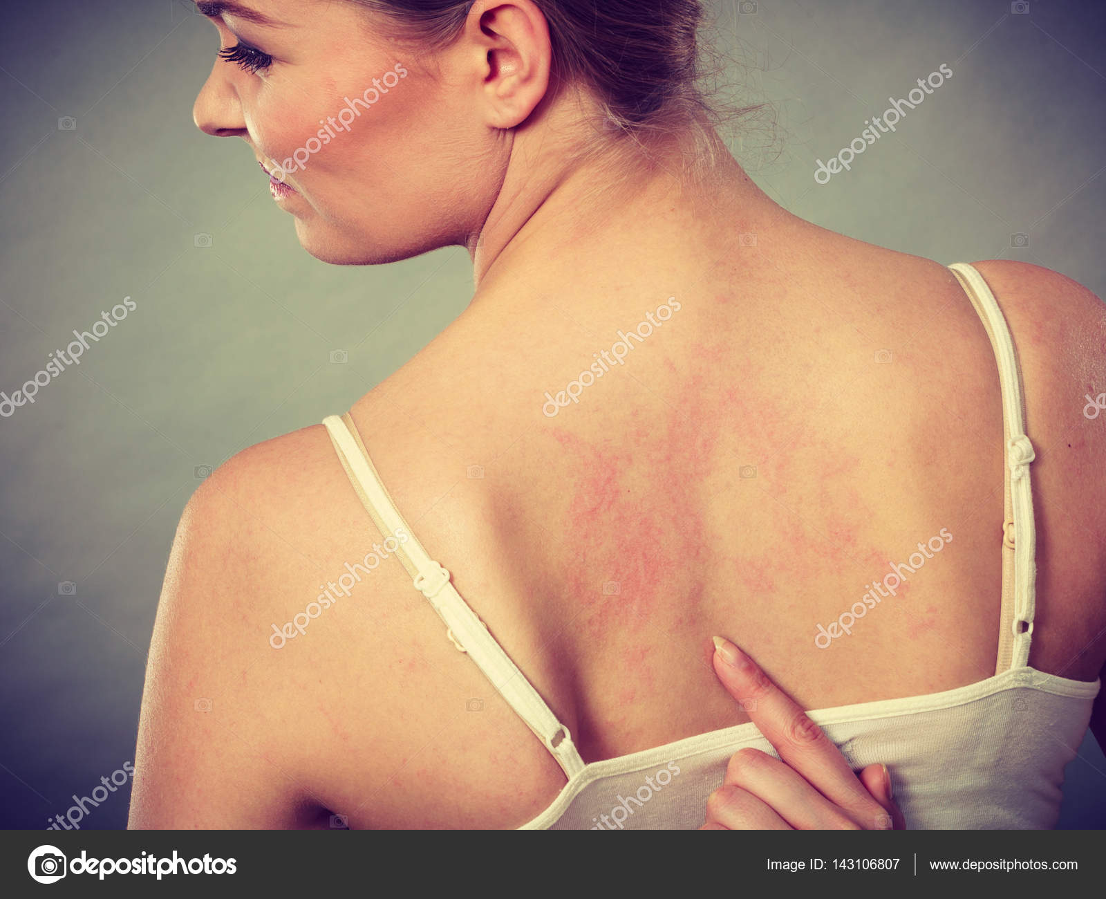 Woman scratching her itchy back with allergy rash Stock Photo by
