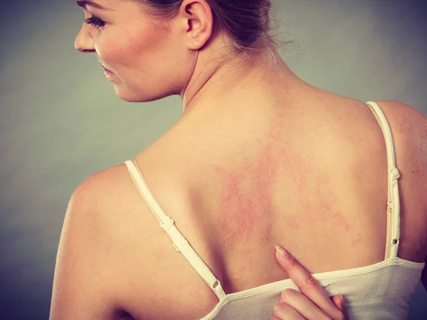 Vrouw haar jeukende terug met allergie huiduitslag krabben — Stockfoto