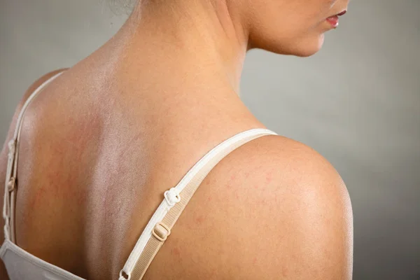 Woman scratching her itchy back with allergy rash — Stock Photo, Image